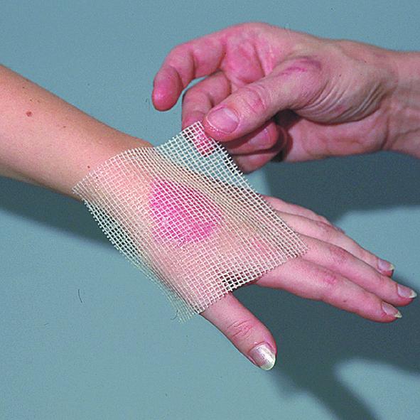 What to Know about Jelonet Wound Dressing | San Diego Wound Care